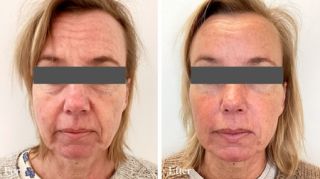 laser depilation k benhavn DermoCosmetic A/S